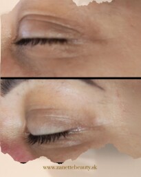 Opuchy očí a vrásky